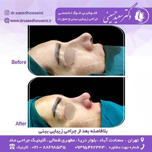 جراحی-زیبایی-بینی-129