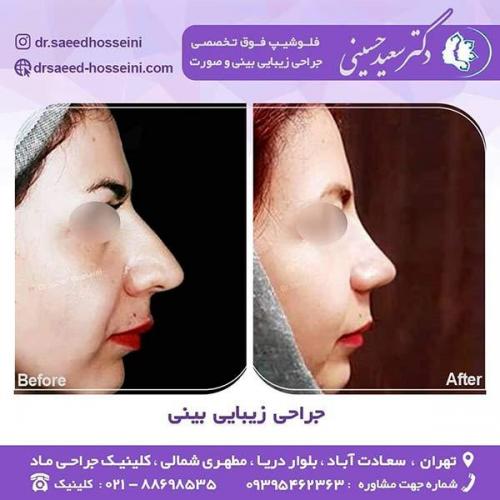 جراحی-زیبایی-بینی-13