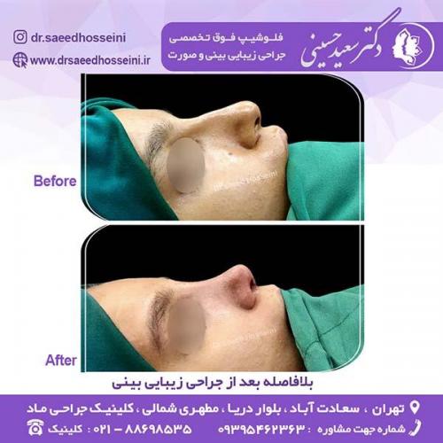 جراحی-زیبایی-بینی-130