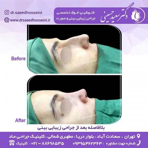 جراحی-زیبایی-بینی-131