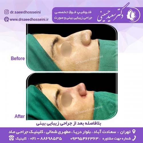 جراحی-زیبایی-بینی-132