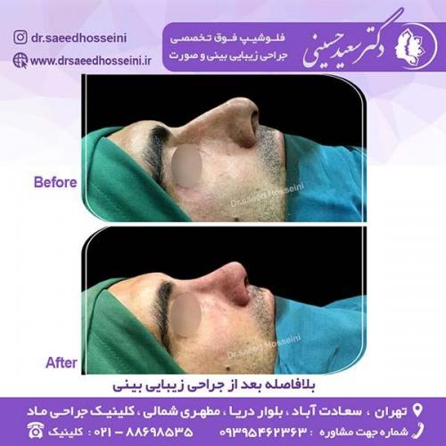 جراحی-زیبایی-بینی-133