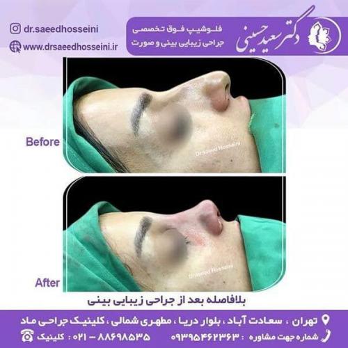 جراحی-زیبایی-بینی-141
