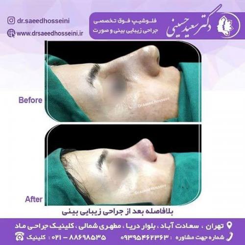 جراحی-زیبایی-بینی-143