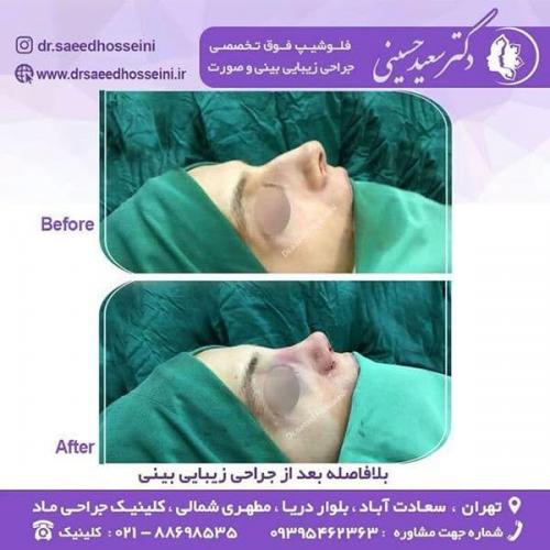 جراحی-زیبایی-بینی-144