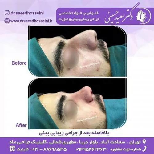 جراحی-زیبایی-بینی-145
