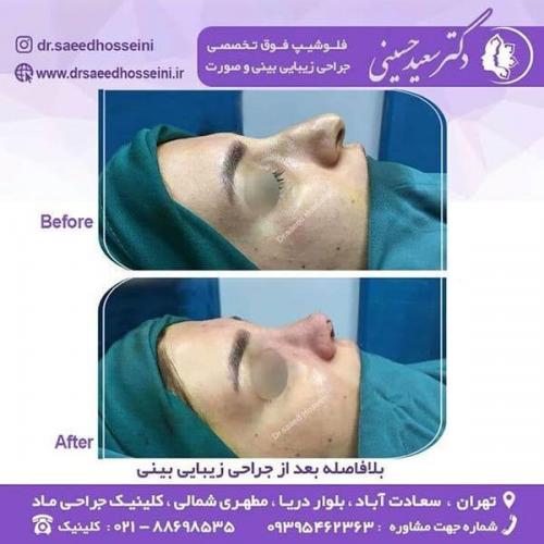 جراحی-زیبایی-بینی-146
