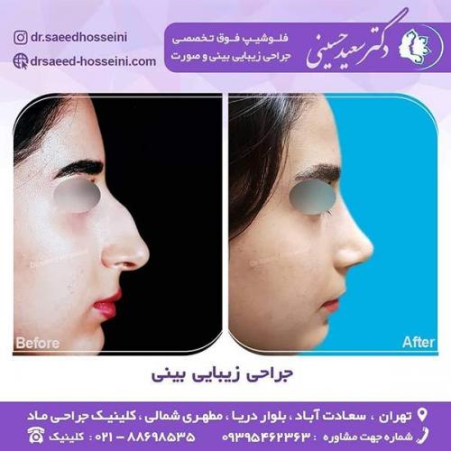 جراحی-زیبایی-بینی-15