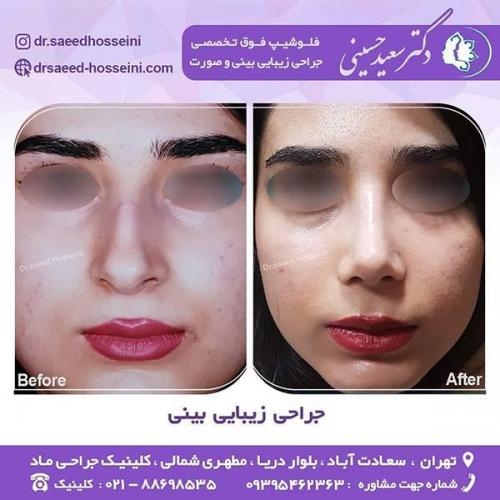 جراحی-زیبایی-بینی-16
