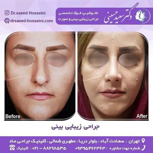 جراحی-زیبایی-بینی-18