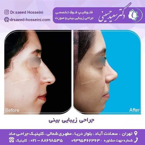جراحی-زیبایی-بینی-19