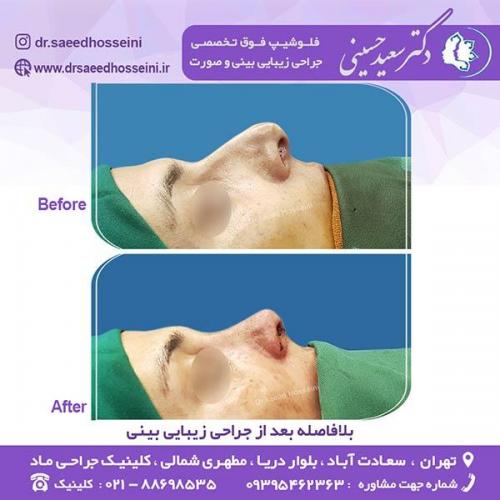 جراحی-زیبایی-بینی-2