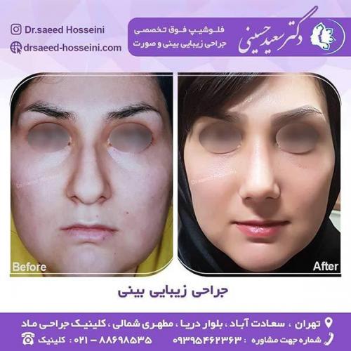 جراحی-زیبایی-بینی-22