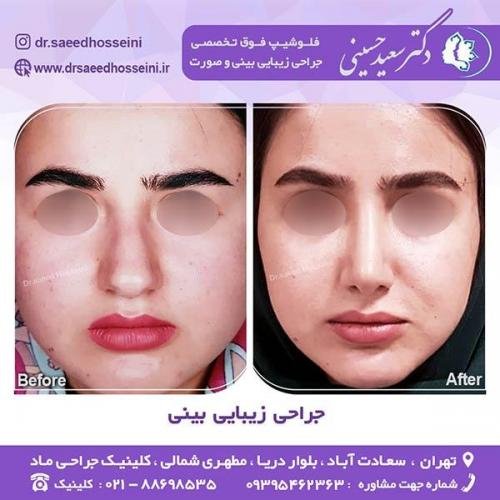 جراحی-زیبایی-بینی-30