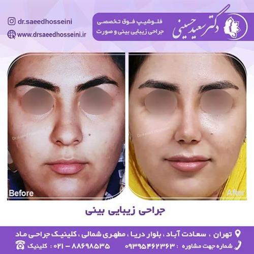 جراحی-زیبایی-بینی-31