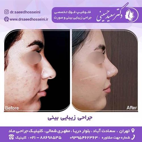 جراحی-زیبایی-بینی-32