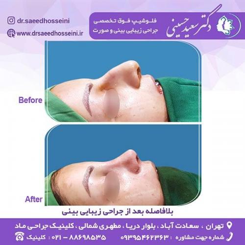 جراحی-زیبایی-بینی-33