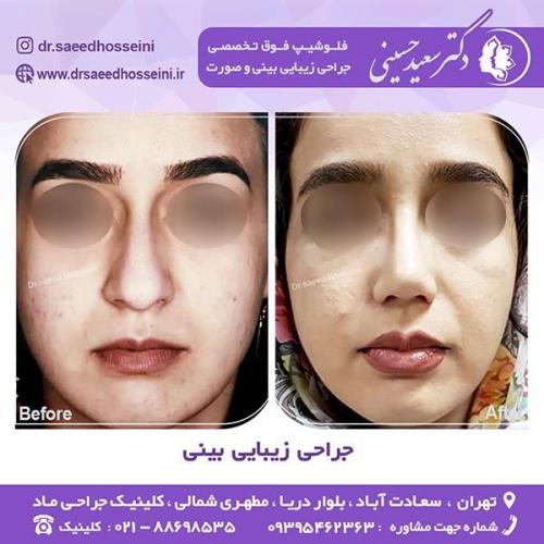 جراحی-زیبایی-بینی-34