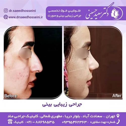 جراحی-زیبایی-بینی-35