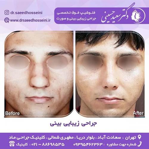 جراحی-زیبایی-بینی-36