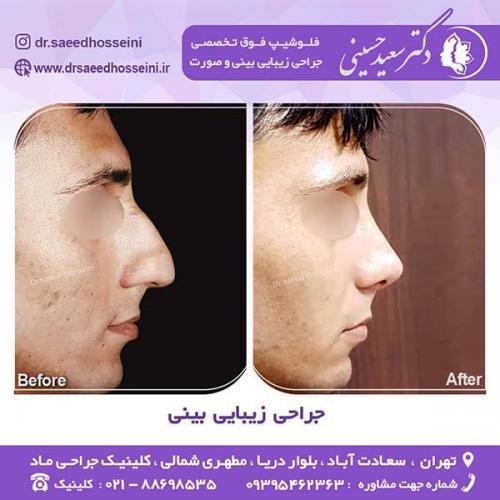 جراحی-زیبایی-بینی-37