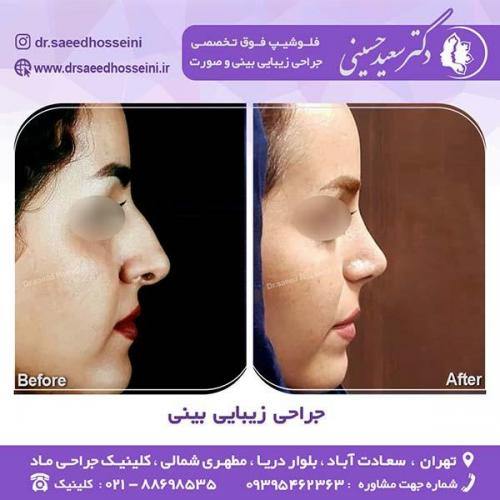 جراحی-زیبایی-بینی-38