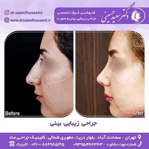 جراحی-زیبایی-بینی-39