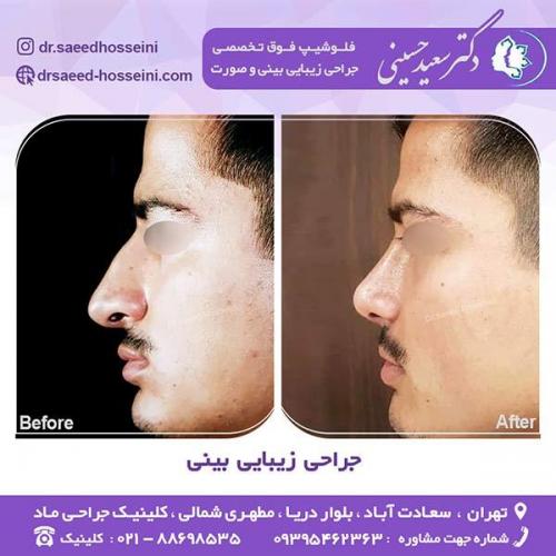 جراحی-زیبایی-بینی-4