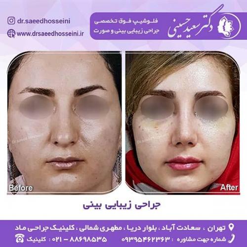 جراحی-زیبایی-بینی-40