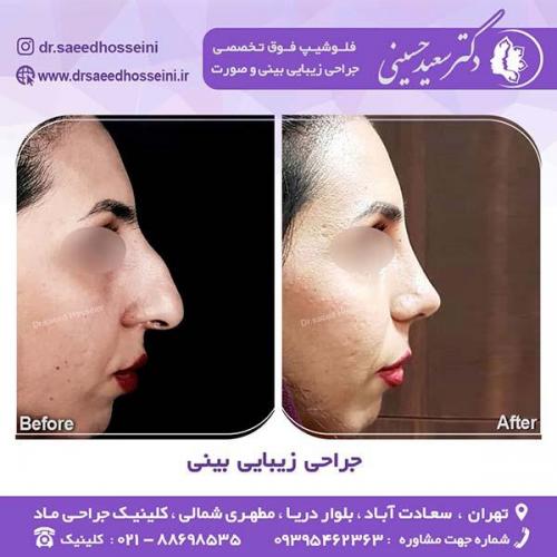 جراحی-زیبایی-بینی-41