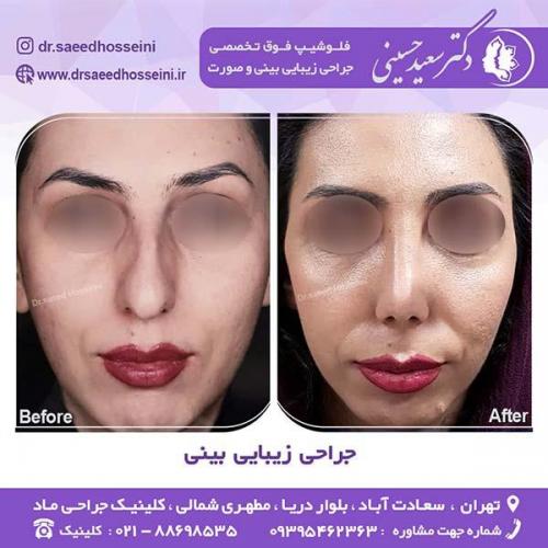جراحی-زیبایی-بینی-42