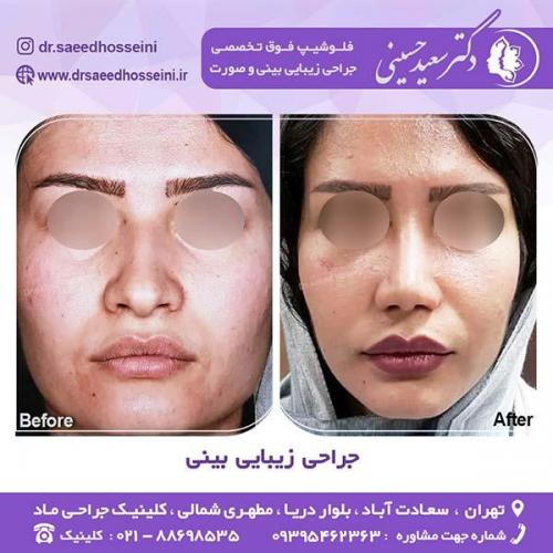 جراحی-زیبایی-بینی-44
