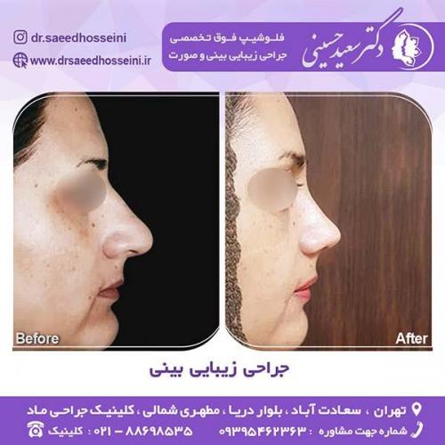جراحی-زیبایی-بینی-45