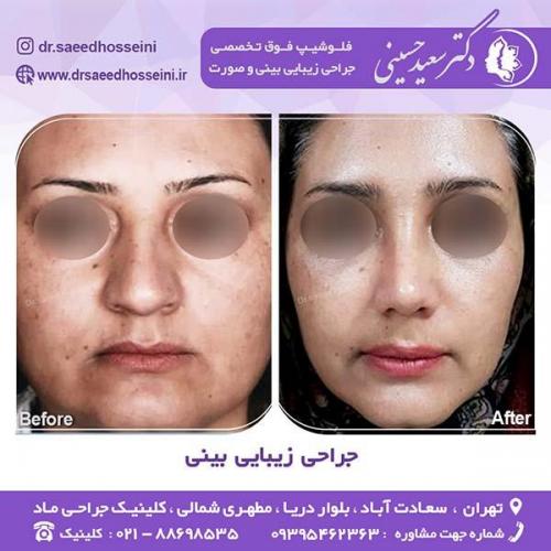 جراحی-زیبایی-بینی-46