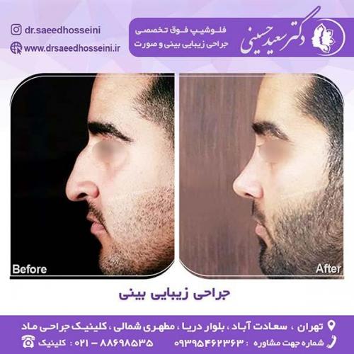 جراحی-زیبایی-بینی-47