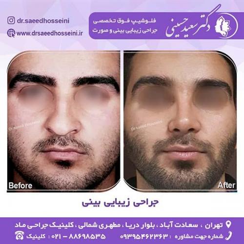 جراحی-زیبایی-بینی-48