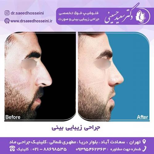 جراحی-زیبایی-بینی-49