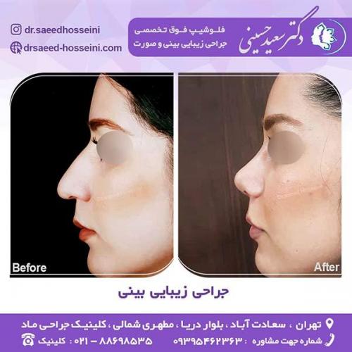 جراحی-زیبایی-بینی-5