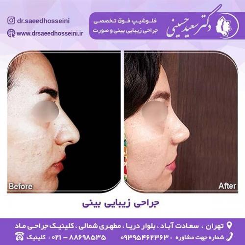 جراحی-زیبایی-بینی-50