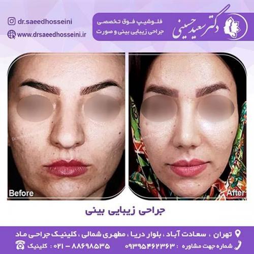 جراحی-زیبایی-بینی-51