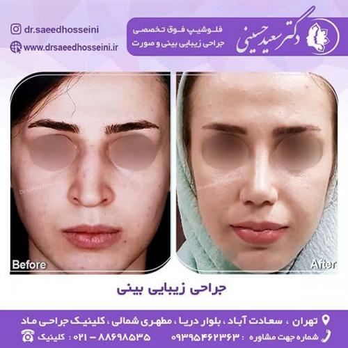 جراحی-زیبایی-بینی-52