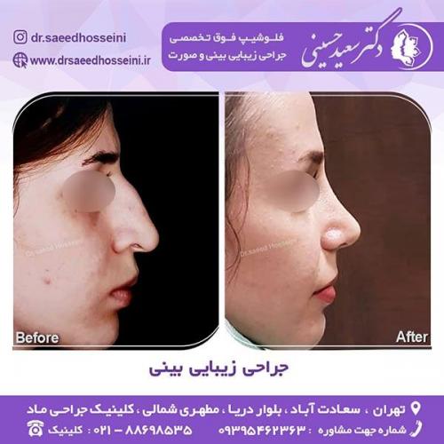 جراحی-زیبایی-بینی-53