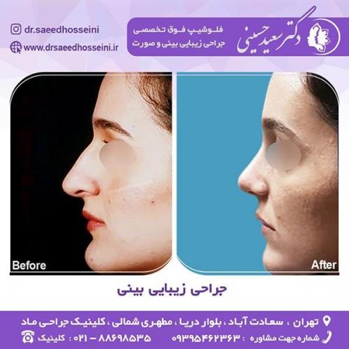 جراحی-زیبایی-بینی-54