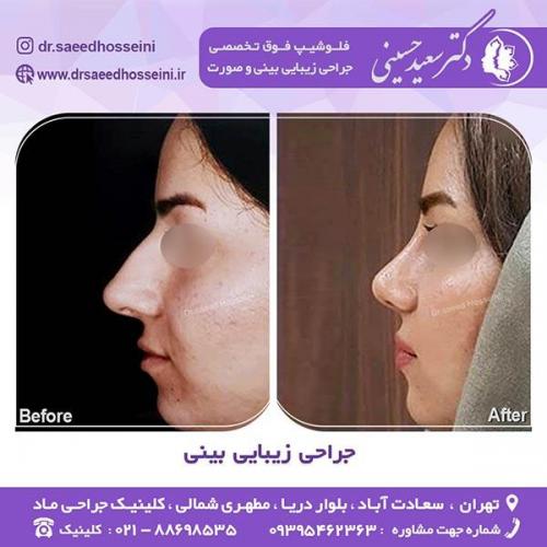 جراحی-زیبایی-بینی-55
