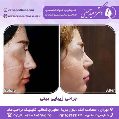 جراحی-زیبایی-بینی-57