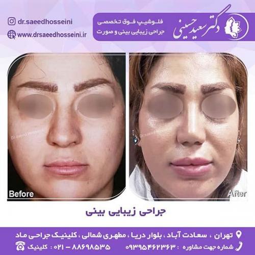 جراحی-زیبایی-بینی-58