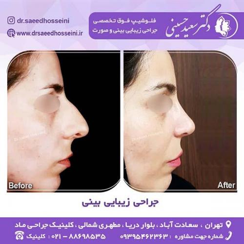 جراحی-زیبایی-بینی-59