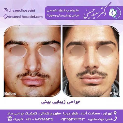 جراحی-زیبایی-بینی-6
