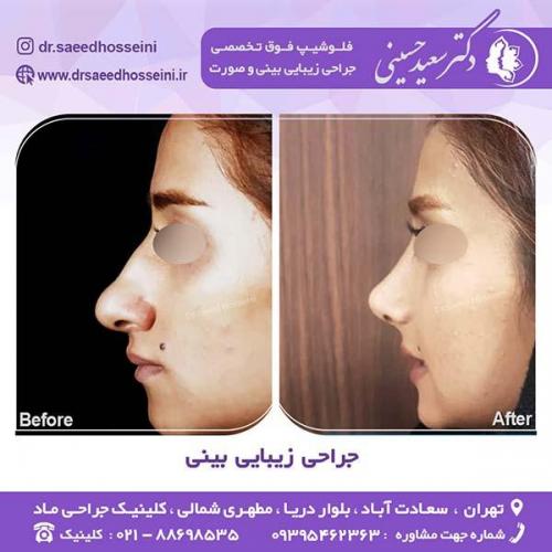 جراحی-زیبایی-بینی-60