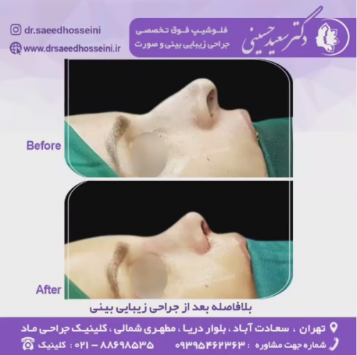جراحی-زیبایی-بینی-62